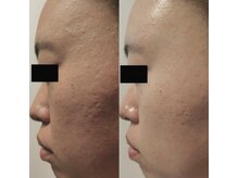 ホワイトアクア 梅田本店(WHITE AQUA)/ララピール/大阪/梅田/毛穴/小顔