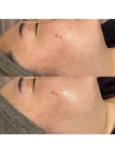 スピカ(Spica)/REVI剥けないハーブピーリング