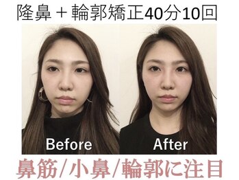 ラプリ 大阪心斎橋店(Raplit)/隆鼻＋輪郭矯正40分10回