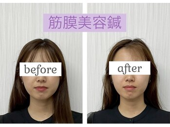 稲川鍼灸接骨院/筋膜美容鍼