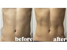 筋膜リリース、ダイエット、引き締め