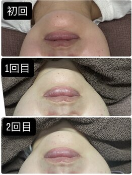 いやされサロン フー(fuu+)/韓国発!脂肪分解剤レモンボトル