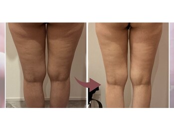 キャンディ 海老名駅前店(Candy)の写真/【大人女性に人気】薄着の季節やドレス姿に自信◎二の腕・背中ハミ肉をボディーマイクロ波リフトで徹底ケア