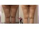 キャンディ 海老名駅前店(Candy)の写真/【大人女性に人気】薄着の季節やドレス姿に自信◎二の腕・背中ハミ肉をボディーマイクロ波リフトで徹底ケア