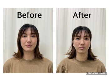 まごころ整骨院/美容鍼Before&After（1回施術）