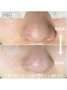ムク(MUKU)/毛穴汚れ諦めないで！
