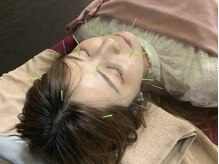 デイジー(DAISY)/美容鍼