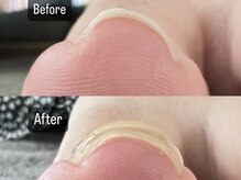 オズ ネイルアンドアイ(OZ NAIL&EYE)/巻き爪改善ジェル一回目
