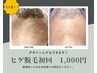 メンズ【都度払い脱毛】ヒゲ脱毛　￥1000