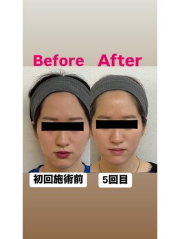 ゆうはり鍼灸整骨院 恵比寿/お客様Before　After
