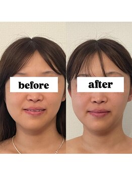 キプラ 福津店(KIPURA)/20代 小顔矯正 1回目