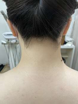 ピエールヘアーマーケットの写真/毎日のムダ毛処理を楽にしませんか？気になる背中や首回りのムダ毛もプロの手で美しくいたします◎