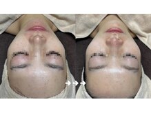 フロラスキン 銀座Miel店(florasKIN)/肌質改善プログラム