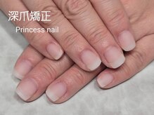 プリンセスネイル(Princess nail)/深爪矯正