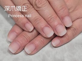 深爪矯正