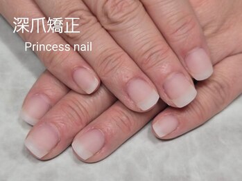 プリンセスネイル(Princess nail)/深爪矯正