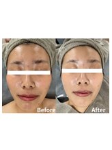 エルア 尼崎(Elua)/医療提携ハーブピーリング