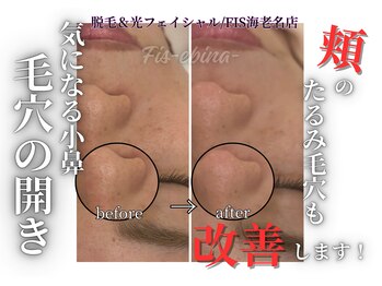 フィズ 海老名店(FIS)の写真/【肌トラブルの改善】毛穴の開き・にきびの跡・目元のしわや頬のしみ、紫外線ケアに♪