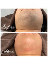 ドクターヘア 徳島店(Dr.hair)/モニター様の症例画像です(あご)