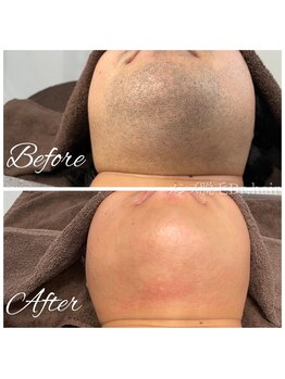 ドクターヘア 徳島店(Dr.hair)/モニター様の症例画像です(あご)