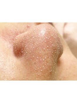 毛穴ケアをしたい