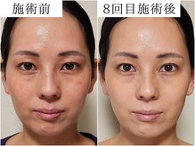 サロンドモフィ(salon de moffy)/美肌【エクソリフト】施術例３