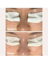 ルル(RuRu)/毛穴洗浄