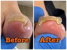 町田市巻き爪センター/1回目の施術