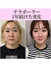 癒える(ielu)/小顔たるみケア★テラボーラー 