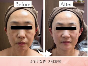 ラグーン(Lagoon)/WINBACK×小顔矯正コルギ