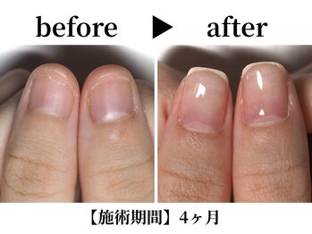 リング ザ ベル(ring the bell)/深爪プレミアムコース¥18,700