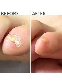 クオッカ(Quokka)/副爪ケア