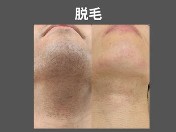 アポロ(Apollo)/【メンズ脱毛】【メンズ眉毛】