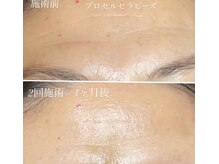 テテメルティ(te-te melty)/プロセルセラピーズ