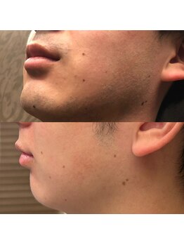 フェリーバ(FELIVA)/Before&After