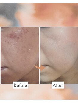 東洋経絡エステ アンド リラクゼーション/大人気全顔シミケア放題