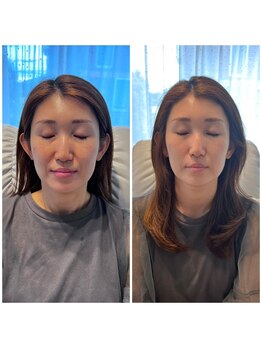 ミラ 中央林間(mira)の写真/元歯科衛生士が提案する小顔EMS！食いしばりやエラはりをケアし、ダクトピールで美肌へ☆