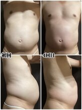 ヴィー(VII)/痩身エステbefore after