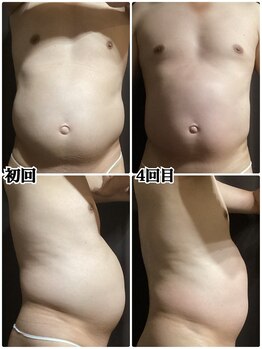 ヴィー(VII)/痩身エステbefore after