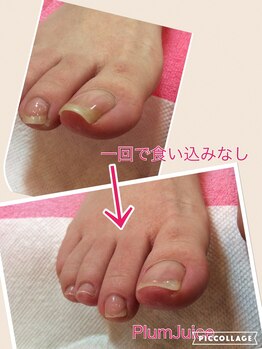 ネイルセラピーサロン プラムジュース(Nail Therapy Salon Plum Juice)/巻爪