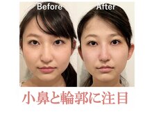 ラプリ 福岡天神店(Raplit)の雰囲気（【美鼻/小顔】日本隆鼻矯正協会認定サロンにしかできない高技術）