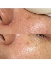 アンドミー(and me)/鹿児島/唐湊/光フェイシャル