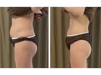 リムアール(Limh R)/ビフォーアフター