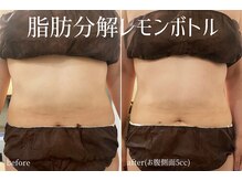 ハティア(hattia)/部分的に脂肪分解！レモンボトル