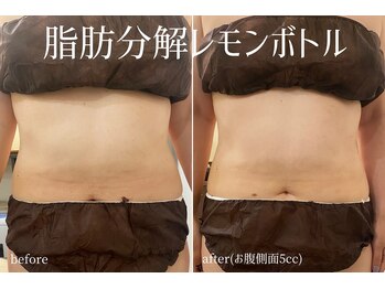 ハティア(hattia)/部分的に脂肪分解！レモンボトル