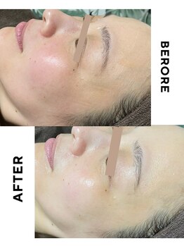 ゼロ(ZERO)/シミシワ肌質改善スペシャル