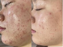 レシェルサロン(Lechelle Salon)/ハーブピーリング＋オプション