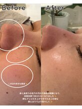 ニコ(nico)/毛穴レスは作れる