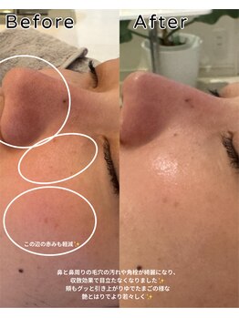 ニコ(nico)/毛穴レスは作れる