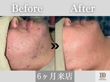 ビューティーアンドボディメイクBB シャオ西尾店/青ヒゲがなくなり肌のトーンUP♪